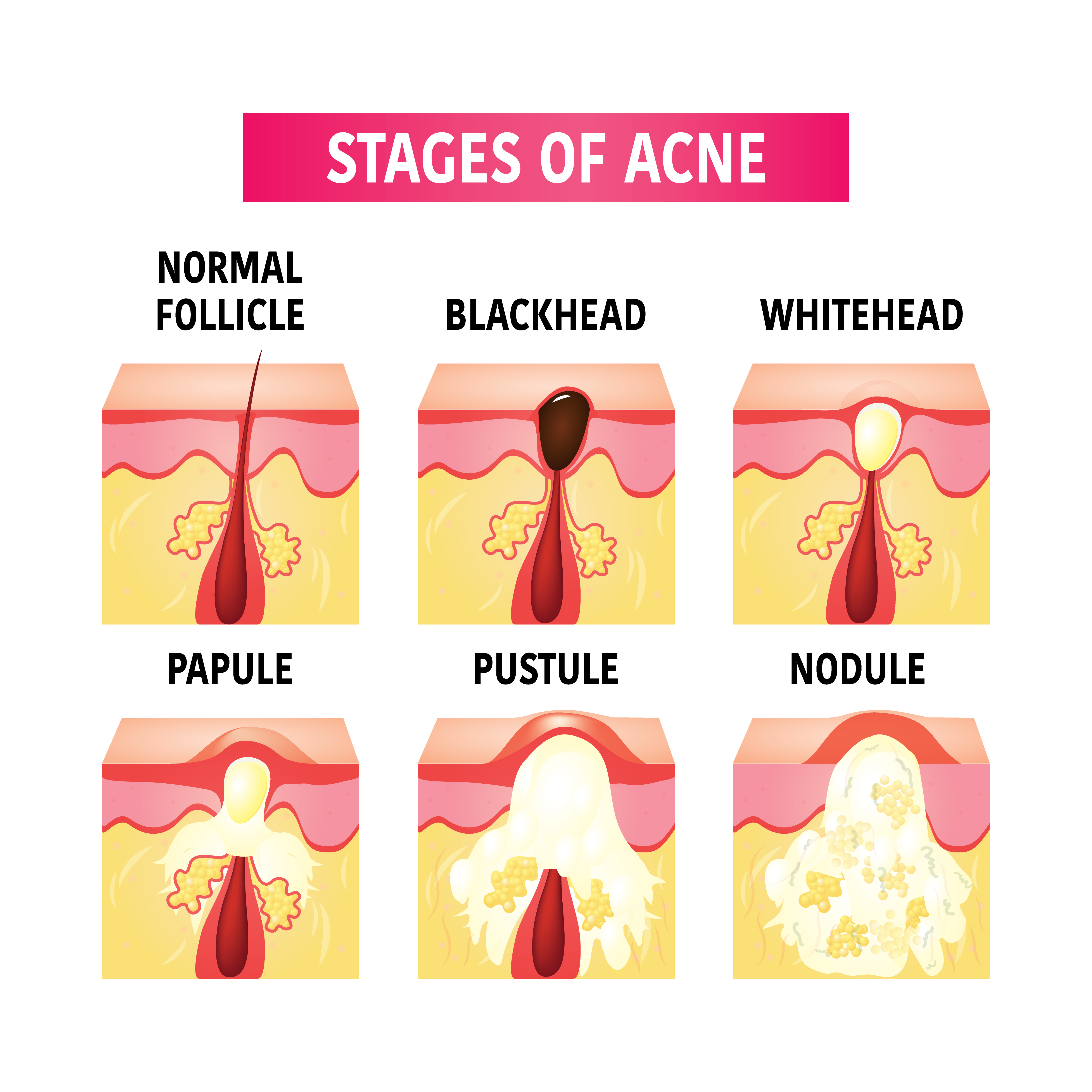 How acne develops - infographic