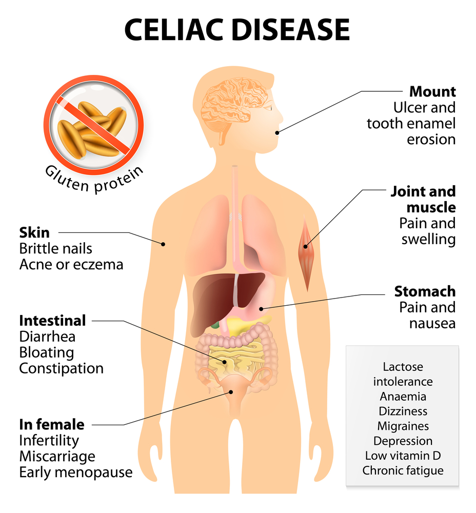 Celiac disease is main reason of glutenophobia! Is actual gluten intolerance disease