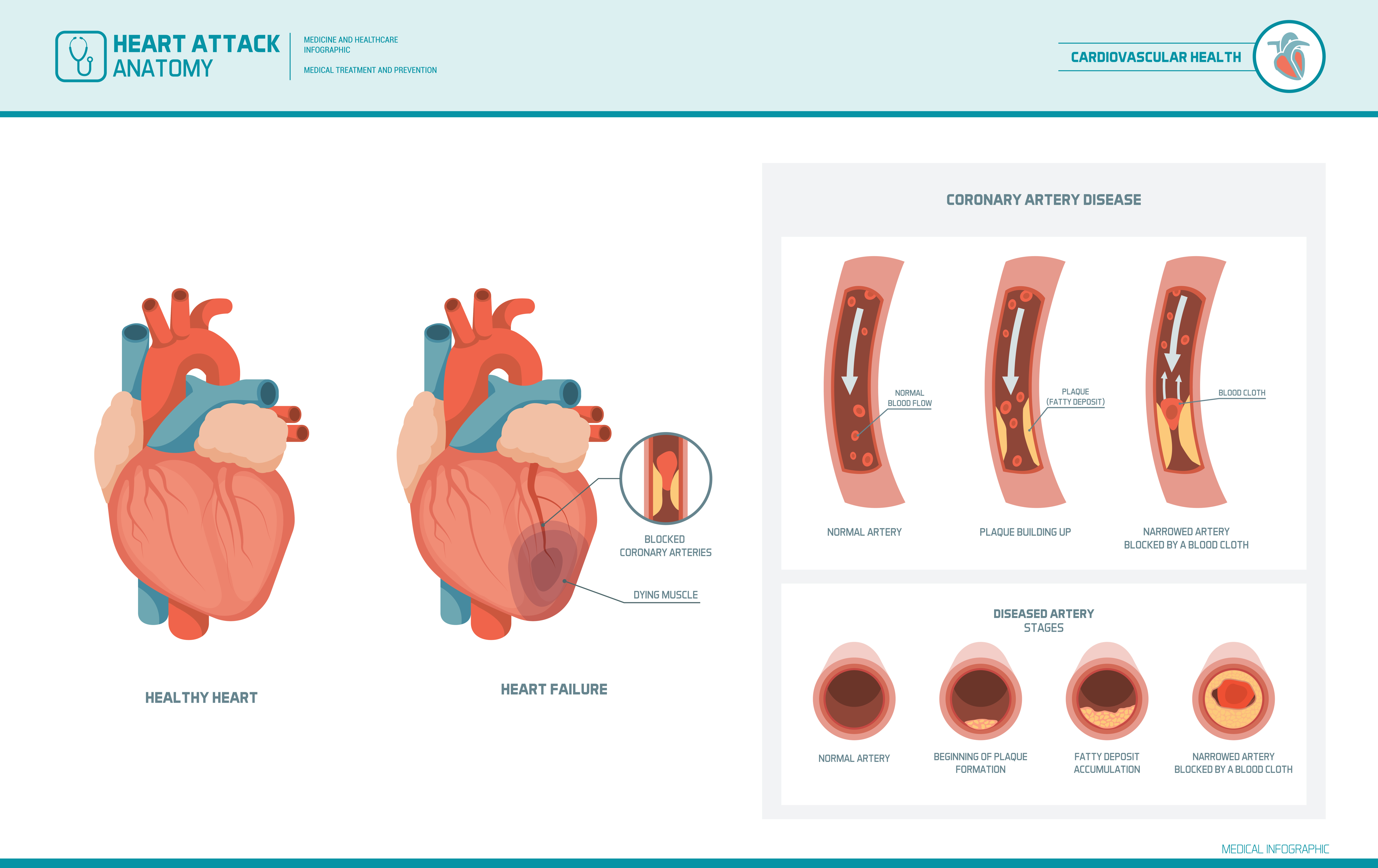 Hypercholesterolemia effects - infographic