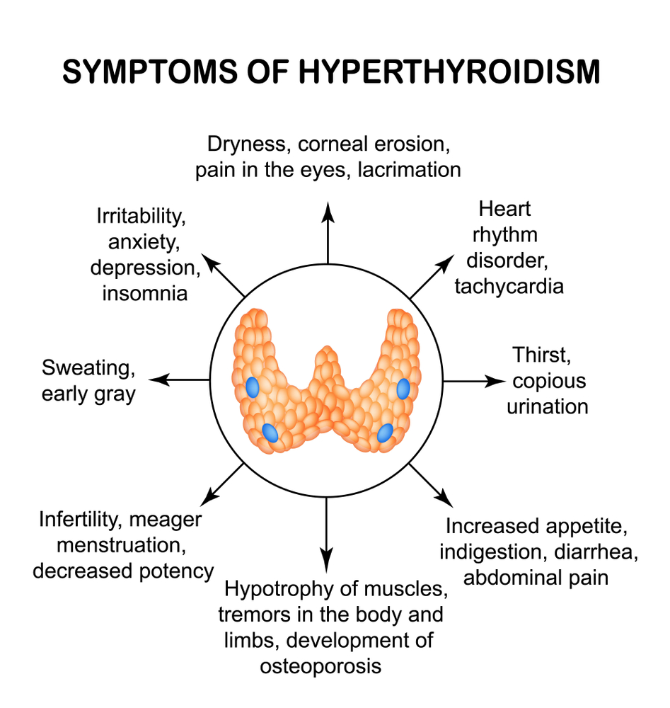 Symptoms of hyperthyroidism