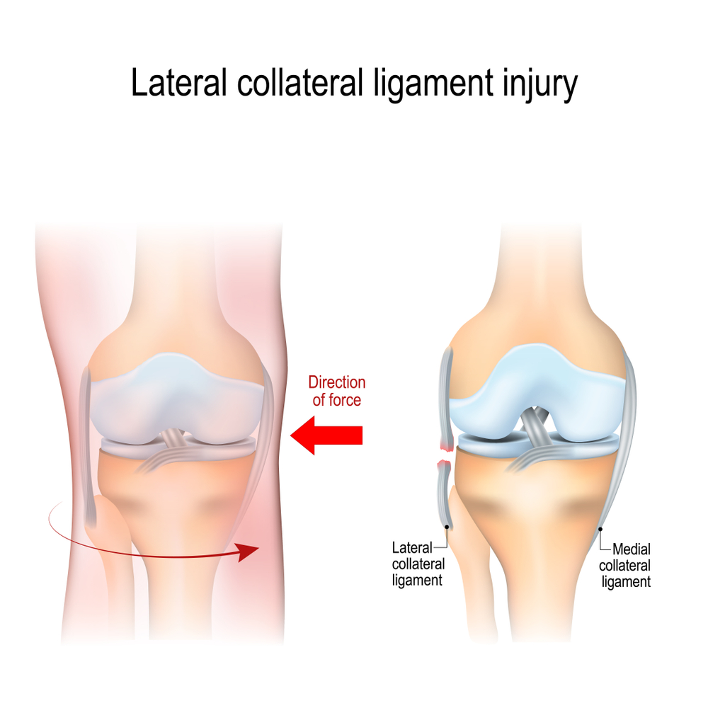 Tendonitis - what is it and how does it look like?