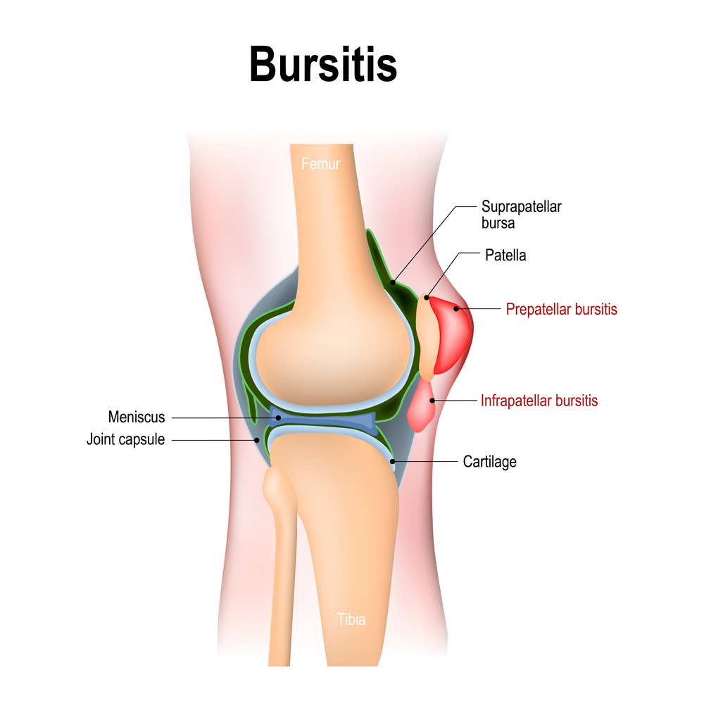 Bursitis - inflammation of bursae. How does it look like?