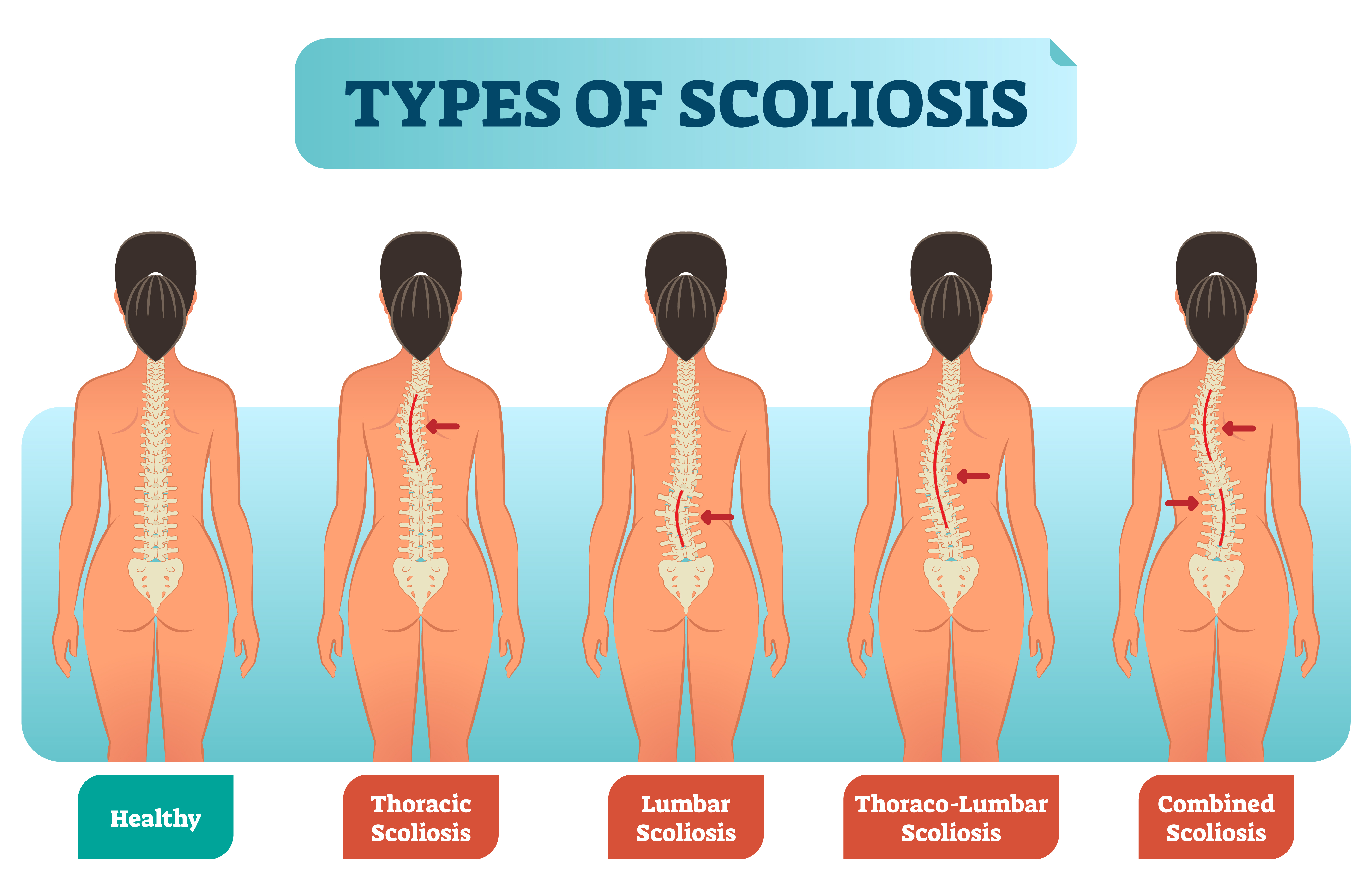 Four types of scoliosis