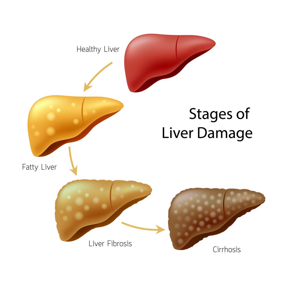 Stages of liver damages in Cirrhosis disease