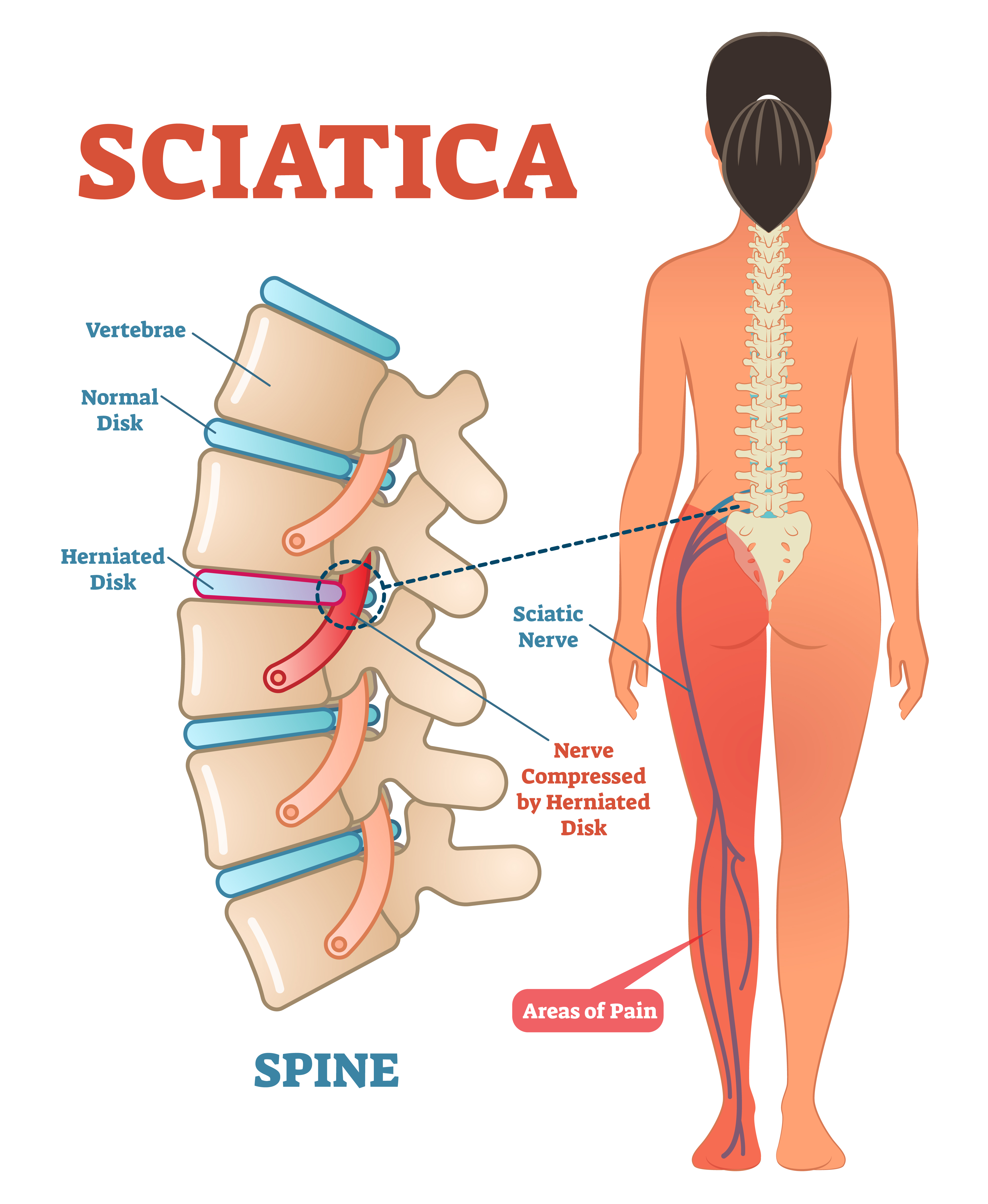 How does Sciatica look like?