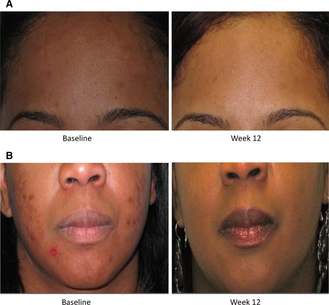Example after 12 weeks of treatment - left before, right after. Image Source: https://www.ncbi.nlm.nih.gov/pubmed/24831048