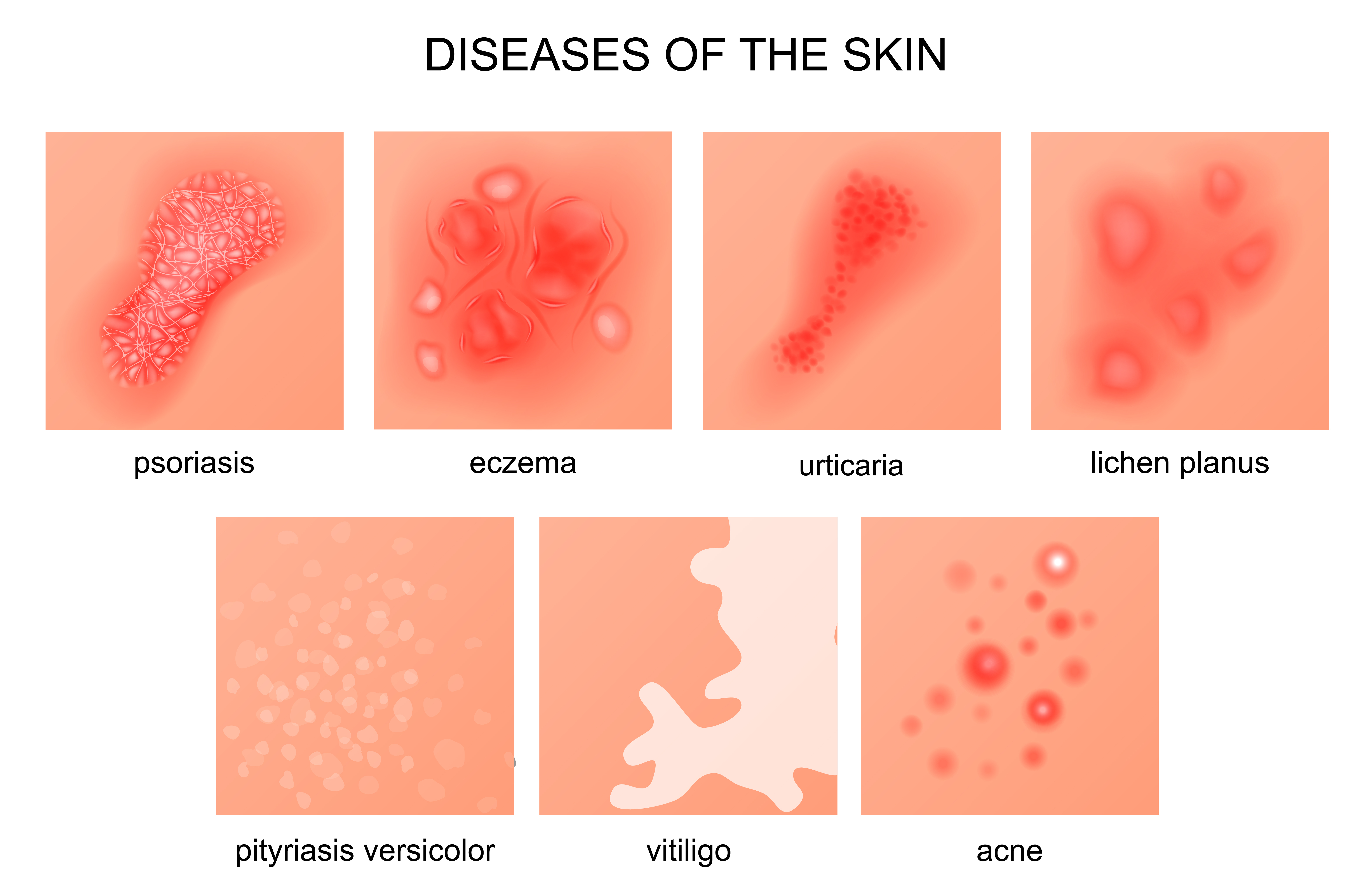 The most popular skin diseases