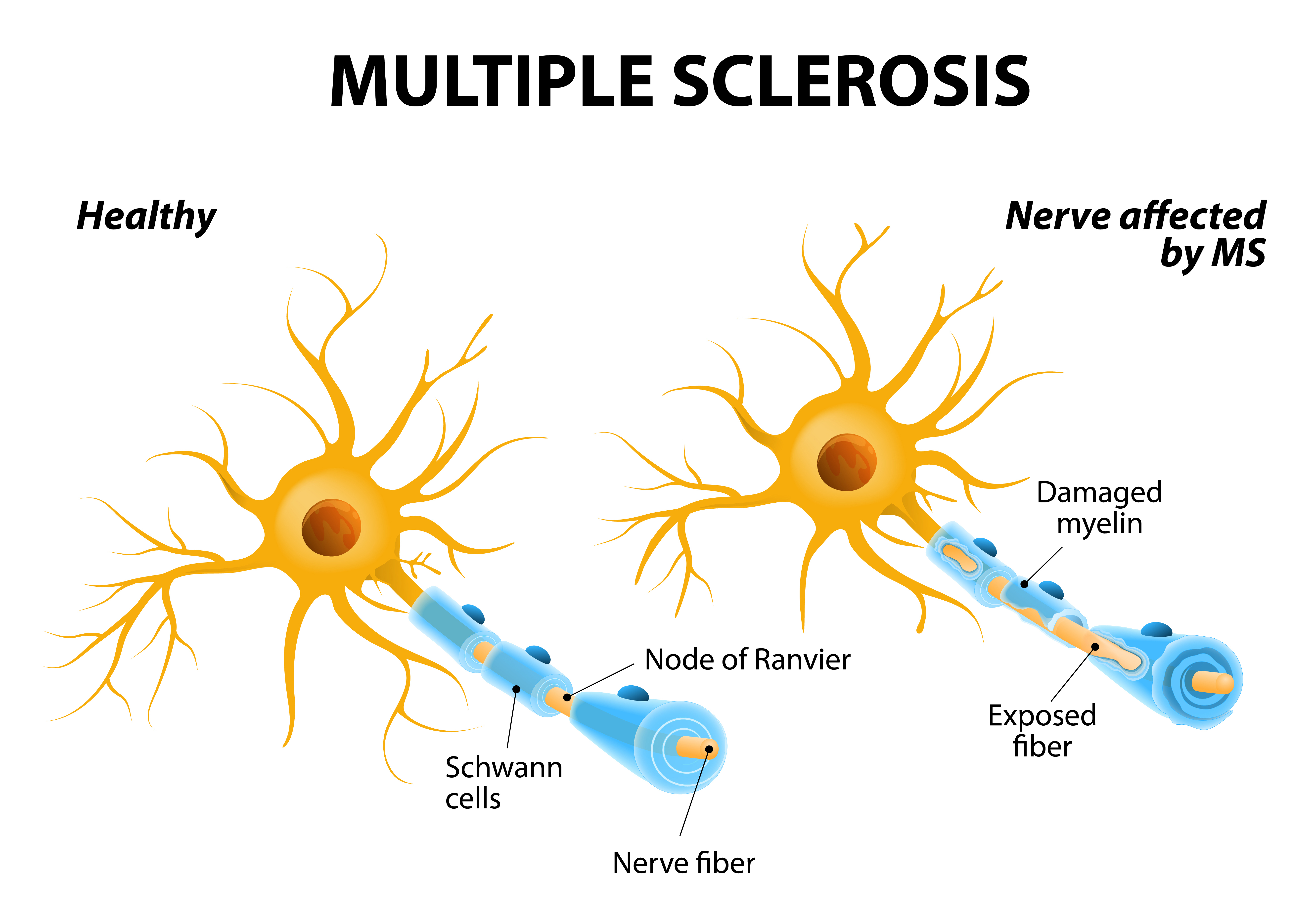 How multiple sclerosis affects nerve cells