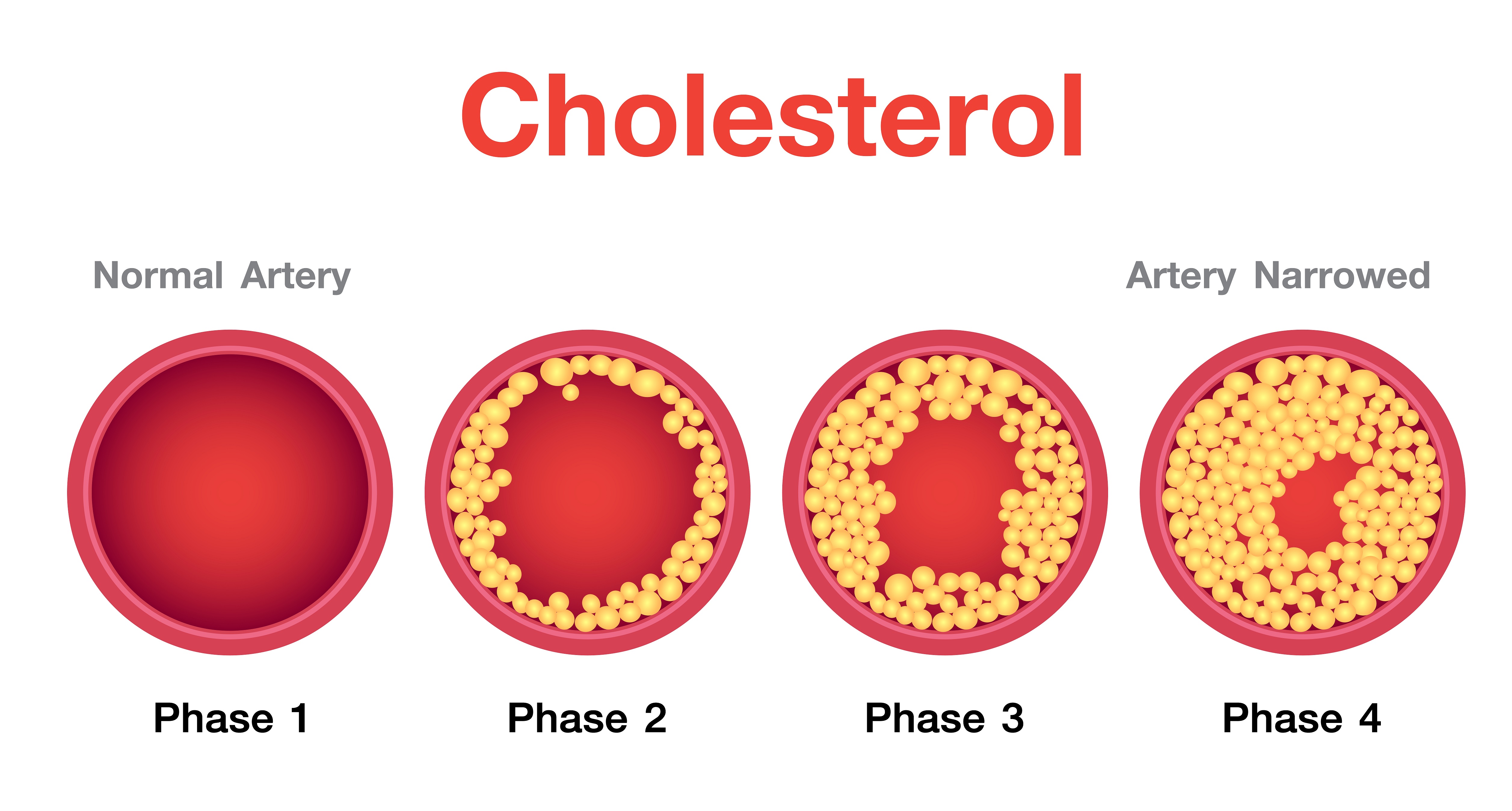 Phases of atherosclerosis