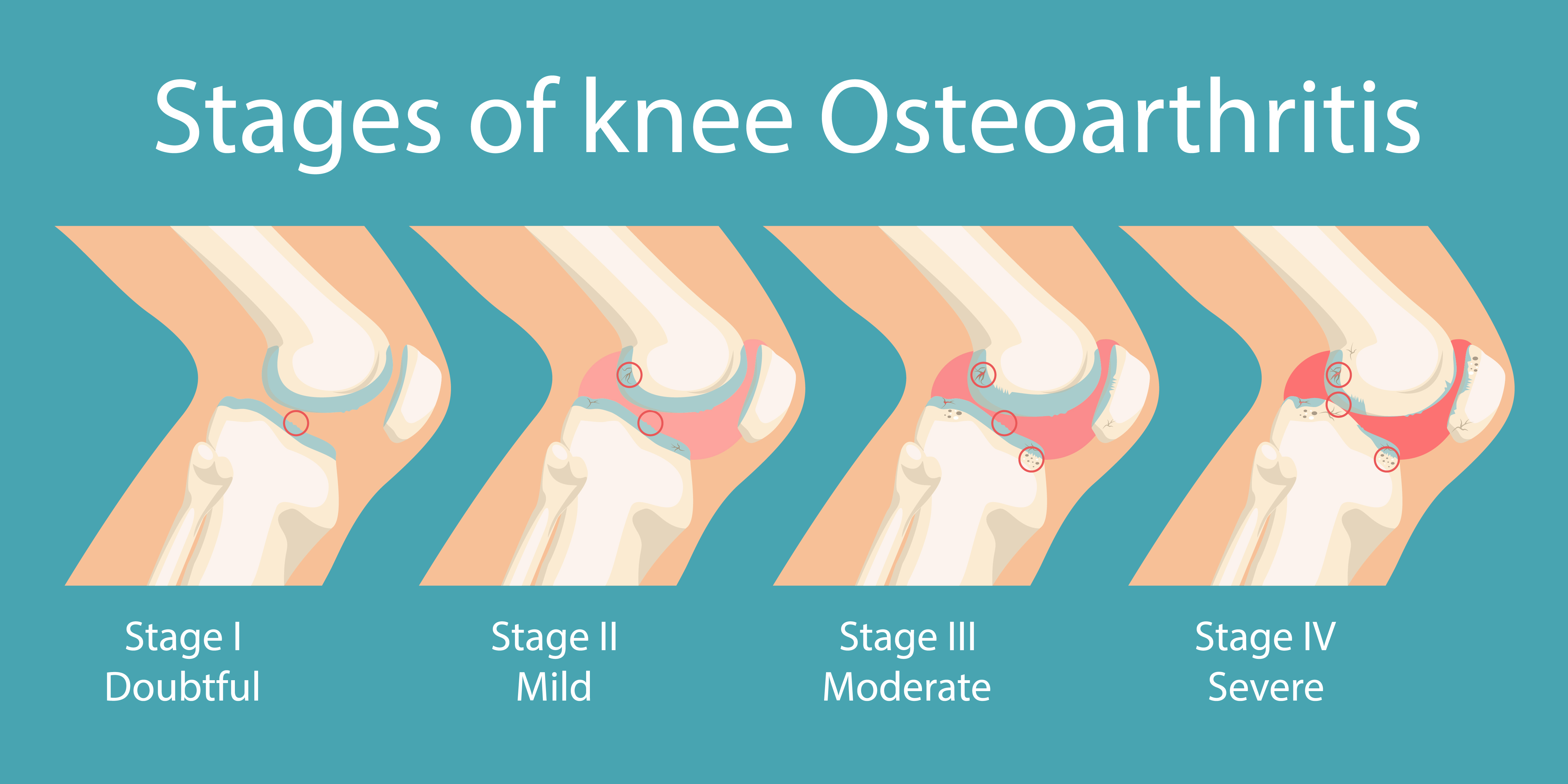 A visualization of osteoarthritis