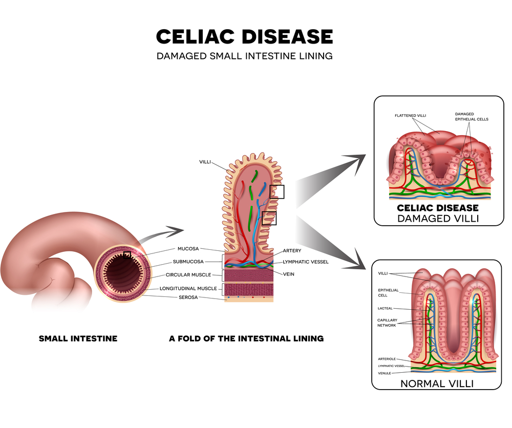 Celiac disease mainly affects the digestive tract