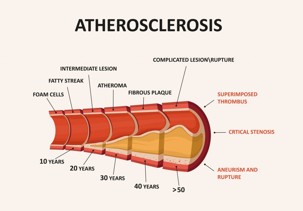 How does Atherosclerosis look like
