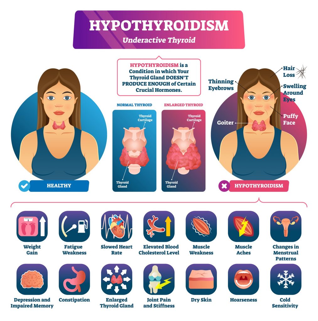 Hypothyroidism infographic