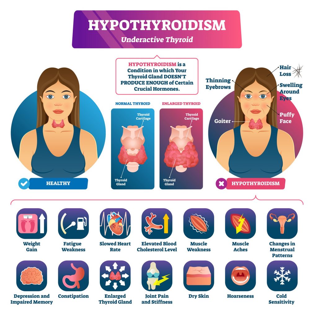 Hashimoto disease infographic