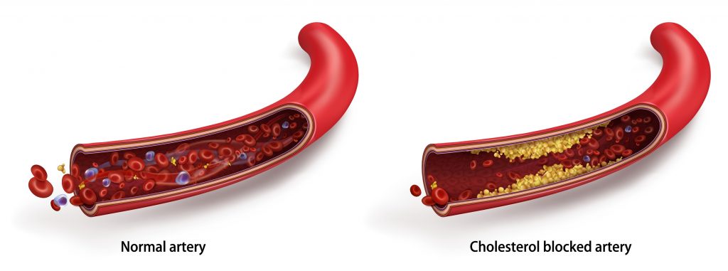 How does cholesterol plaque look like