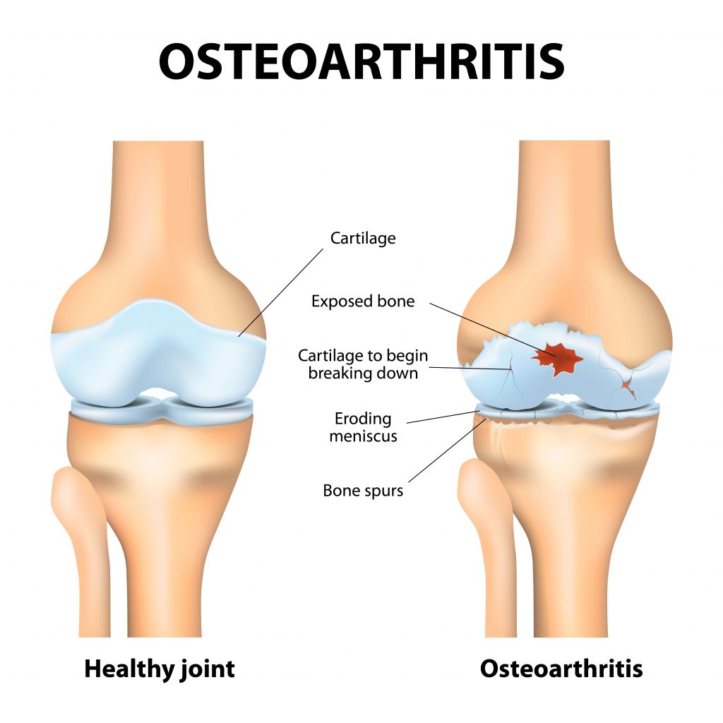Osteoarthritis - a typical disease in which joint degeneration occurs