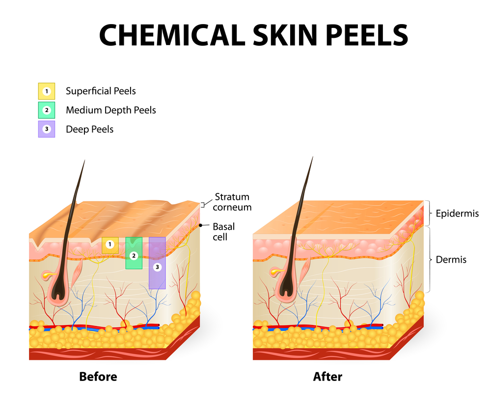 Different types of peelings have different range of applications