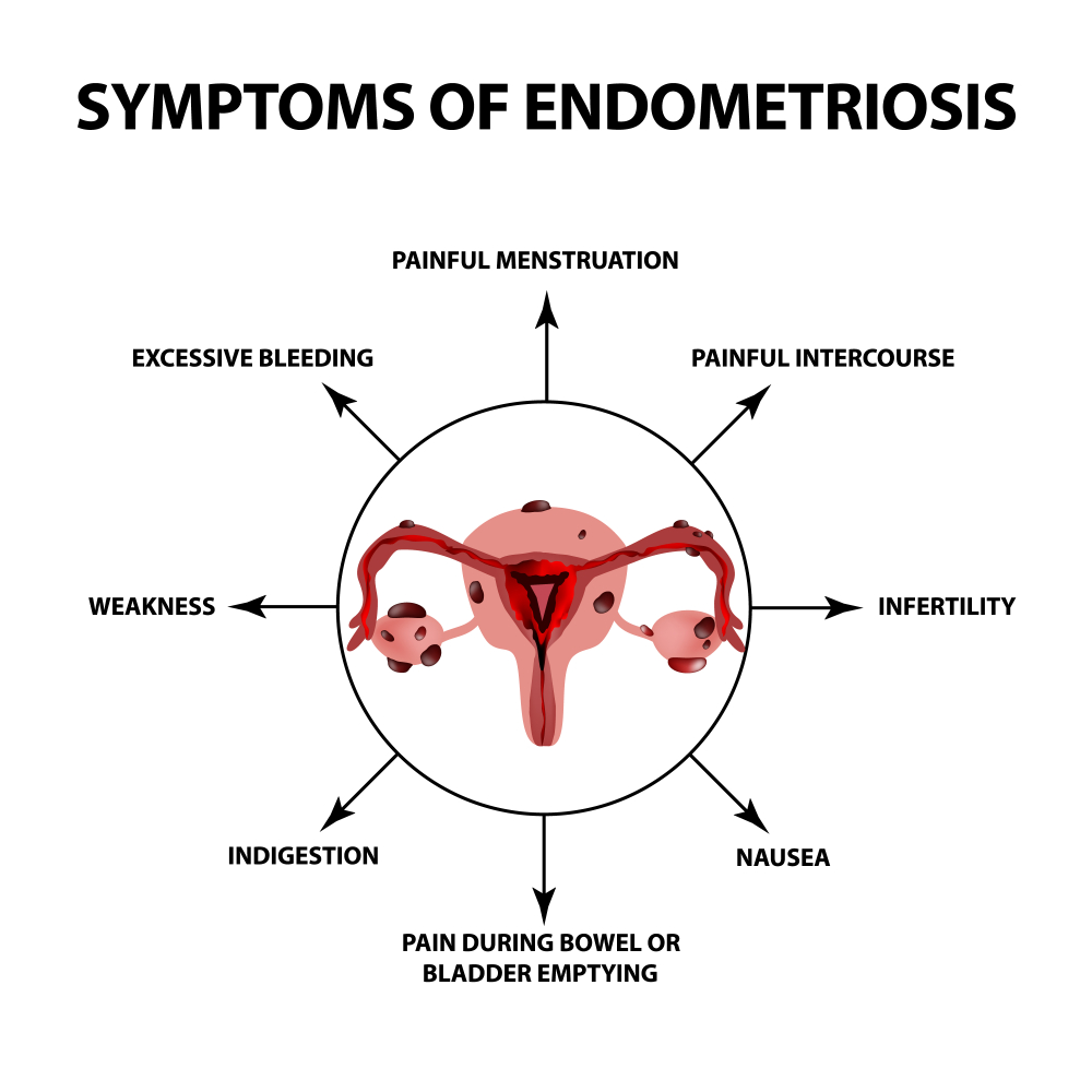 Symptoms of endometriosis