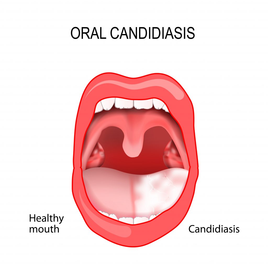 Oral candidiasis - one of the moest known symptoms of this disease