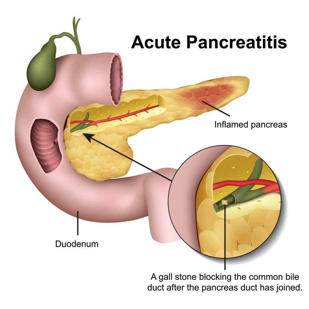 Acute Pancreatitis symptoms