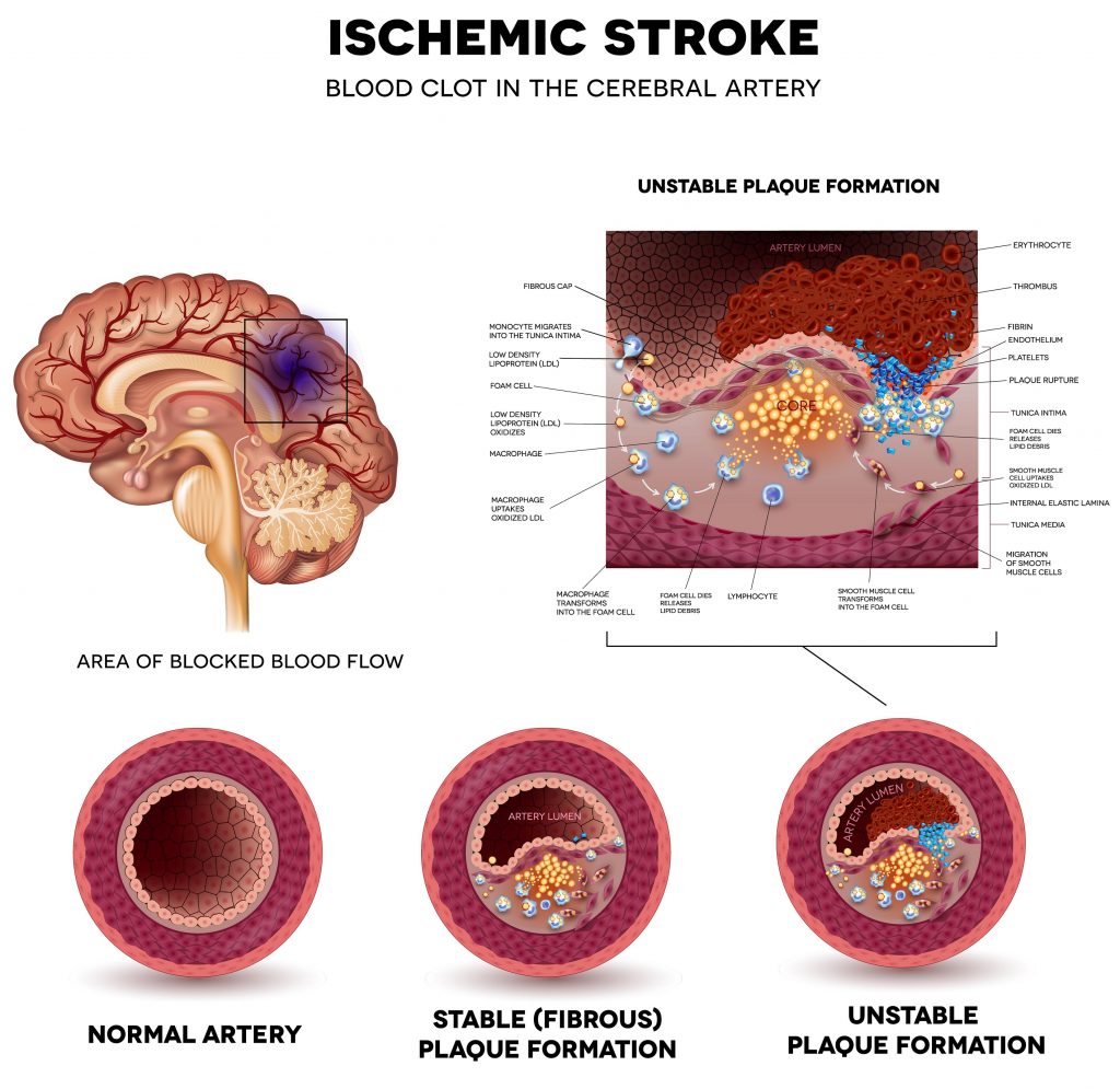 Development of ischemic stroke - infographic